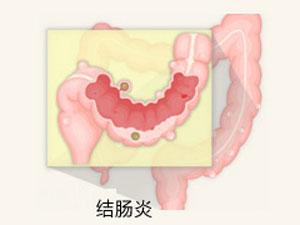 南寧治療結腸炎哪家醫(yī)院好