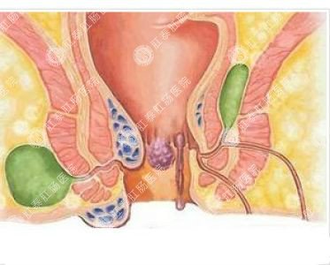 南寧哪個(gè)醫(yī)院可以做肛周膿腫？