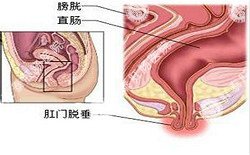 南寧治療脫肛哪家醫(yī)院好？南寧脫肛治療多少錢(qián)？